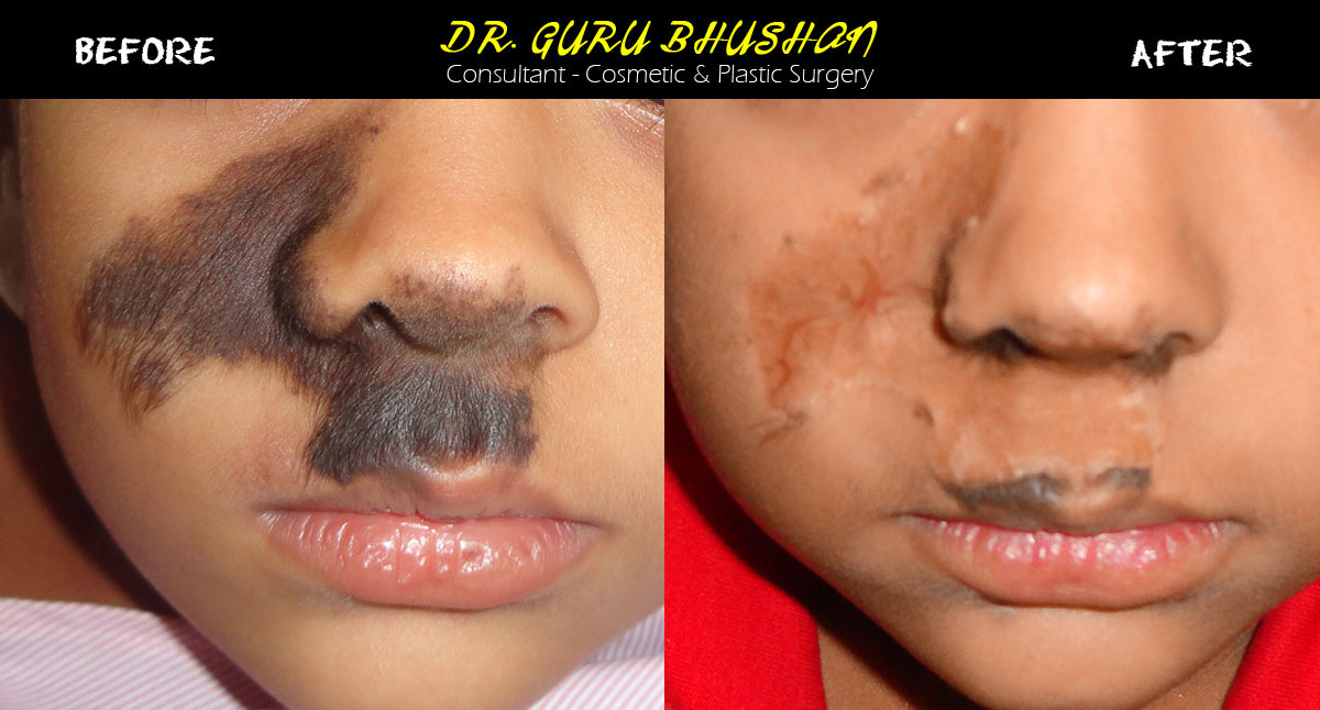 hairy nevus surgery